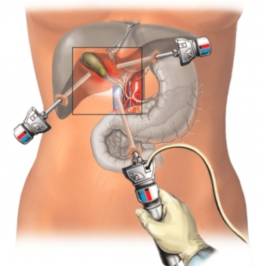 لاپاراسکوپی
