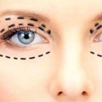 آیا بلفاروپلاستی دائمی است؟