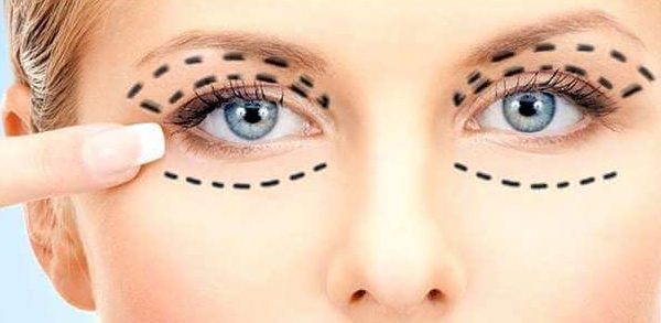 آیا بلفاروپلاستی دائمی است؟