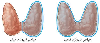 جراحی تیروئید