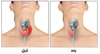 جراحی تیروئید