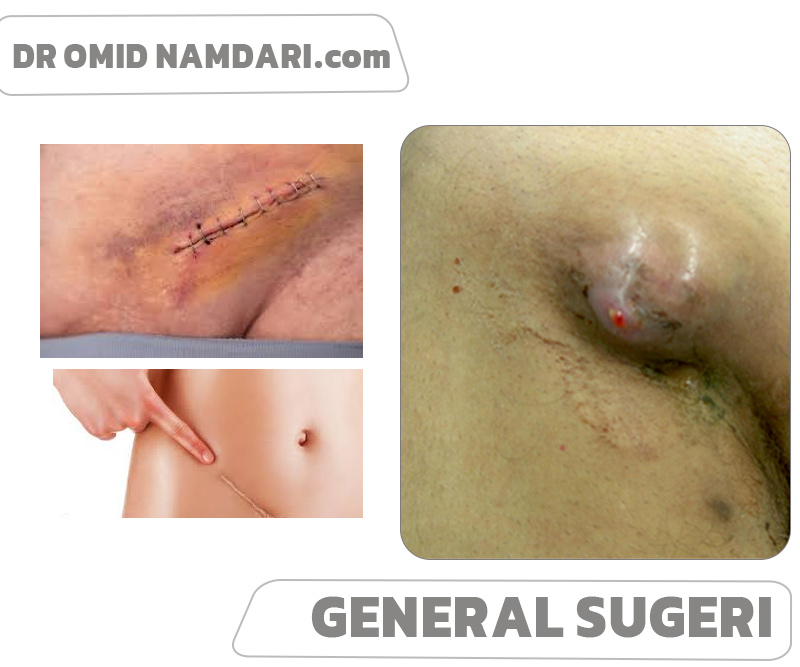 بهترین جراح کشاله ران د رکرج