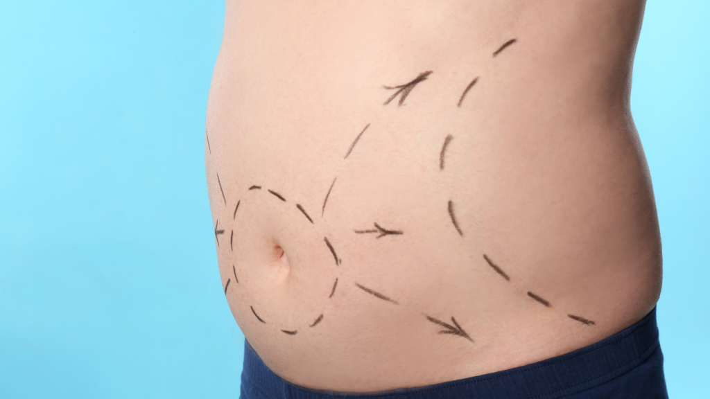 جراحی لیپوساکشن در کرج