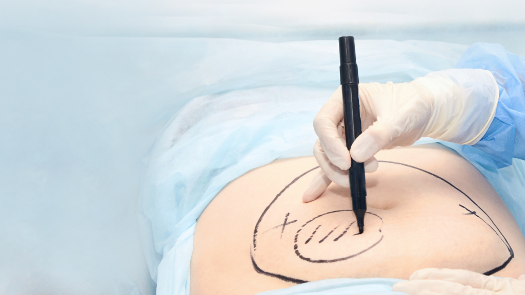 جراحی لیپوماتیک در کرج