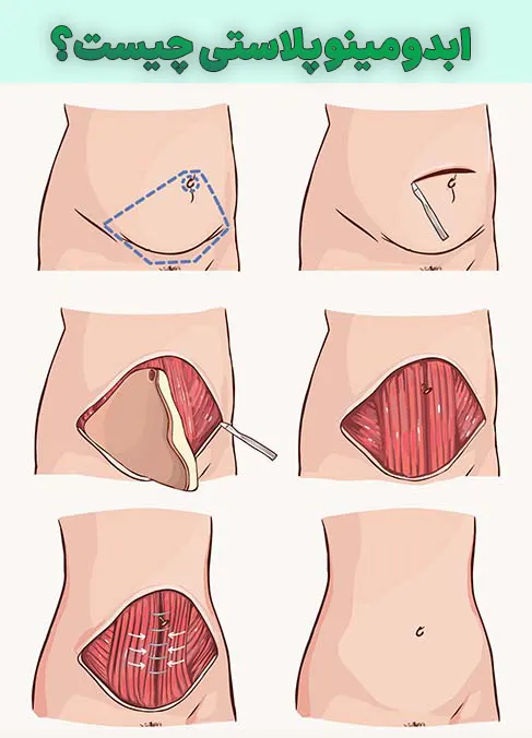 هزینه ابدومینوپلاستی در کرج (۱۴۰۴)