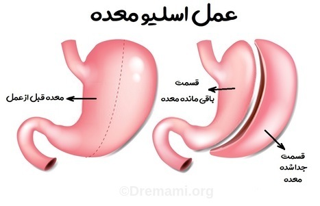 جراحی اسلیو معده