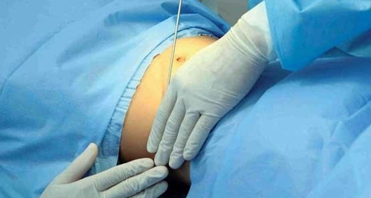 جراحی لیپوماتیک