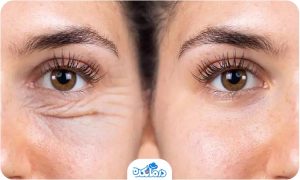 بلفاروپلاستی