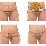 جراحی ابدومینو پلاستی