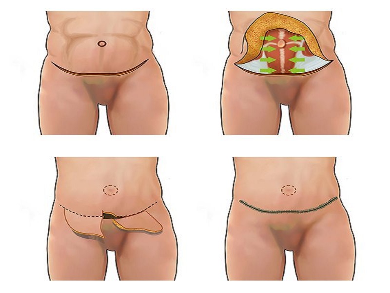 جراحی ابدومینو پلاستی