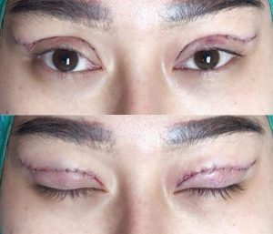 بلفاروپلاستی