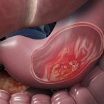 سرطان معده در کرج