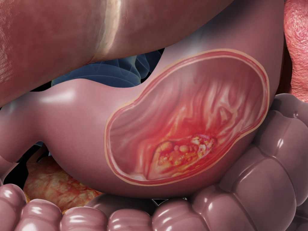 سرطان معده در کرج