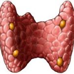 سرطان تیرویید