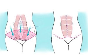 ابدومینوپلاستی در کرج
