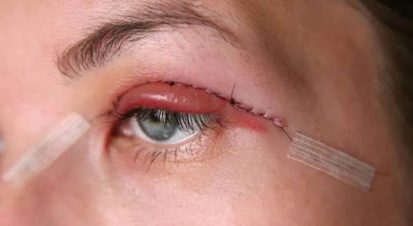 ورم بعد از جراحی پلک چند روز طول میکشد؟